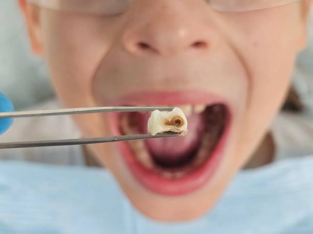 Best Emergency Treatment for Oral Infections in Plymouth, OH